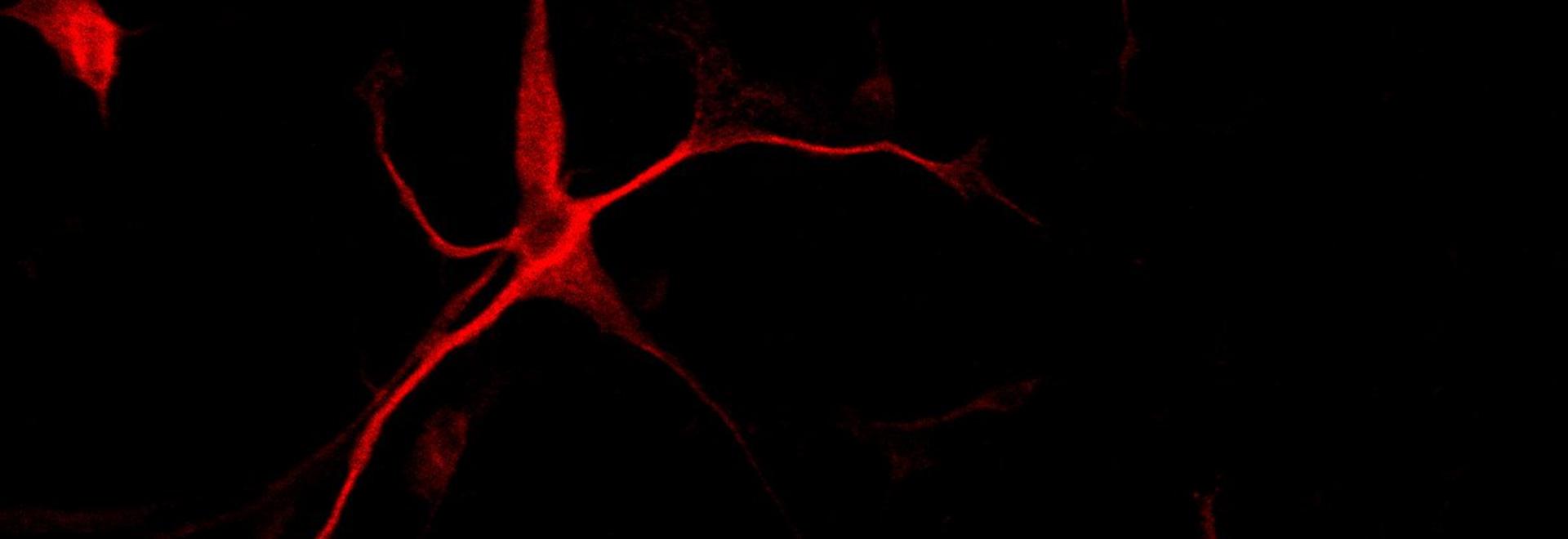 Proliferating brain cancer cells converted to non-proliferating neuronal cells by some drug treatments resulting in inhibition of brain tumor cell growth Proliferating brain cancer cells converted to non-proliferating neuronal cells by some drug treatments resulting in inhibition of brain tumor cell growth