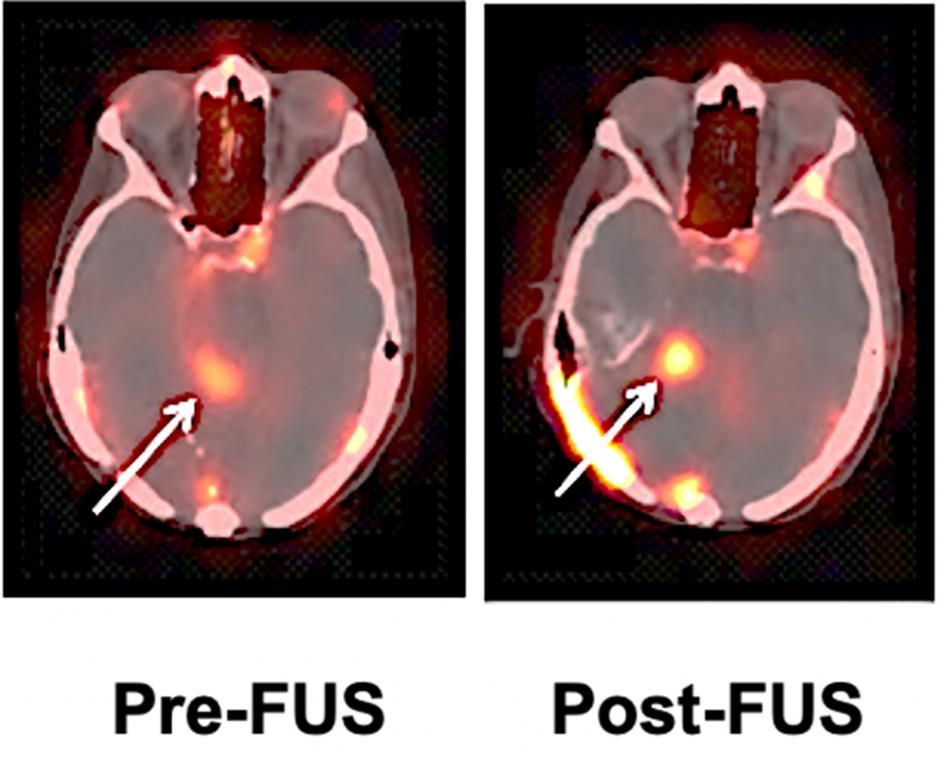 Image of the uptake of radiolabeled trastuzumab (Herceptin)