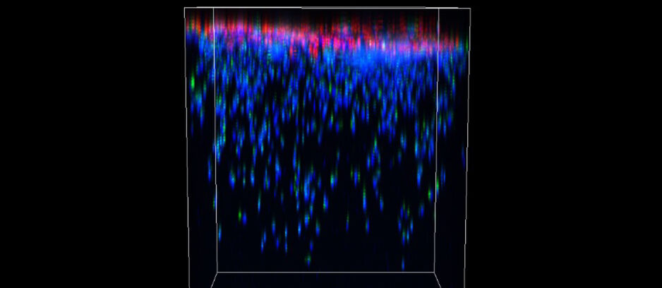 Patient derived glioblastoma stem cells invade into a biomimetic hydrogel as they do in patients.