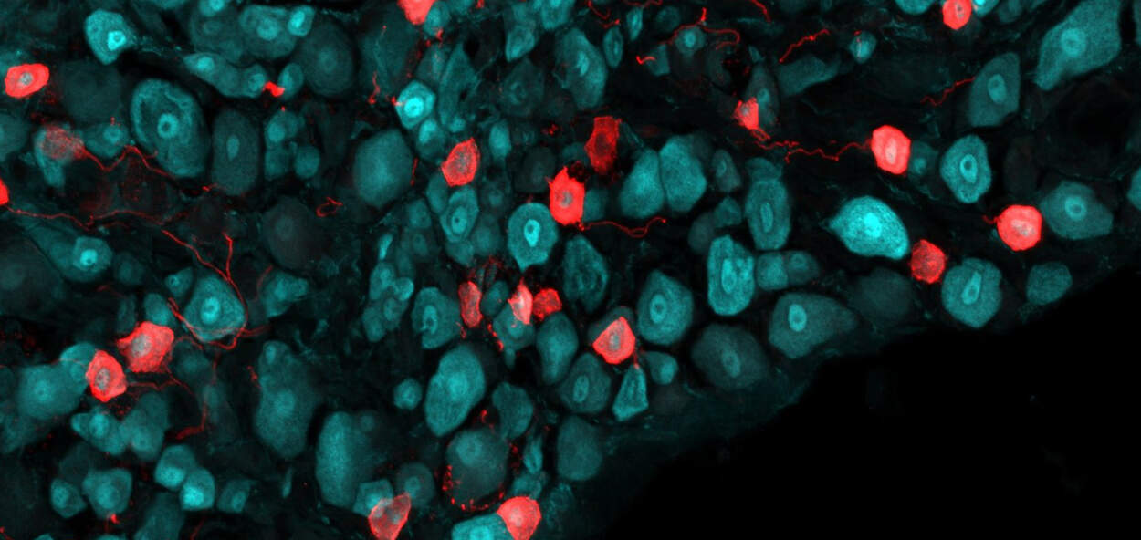 Confocal image of a mouse lumbar DRG with NeuN in blue and ChR2 in red in a transgenic mouse line that expresses channelrhodopsin in select DRG neurons (20X). Courtesy of Dr. Maham Zain. Confocal image of a mouse lumbar DRG with NeuN in blue and ChR2 in red in a transgenic mouse line that expresses channelrhodopsin in select DRG neurons (20X). Courtesy of Dr. Maham Zain.
